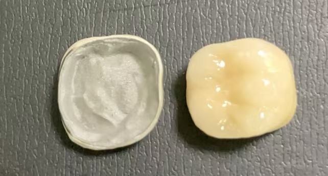 Aké podmienky sú potrebné na získanie korún potápaných porcelánom?