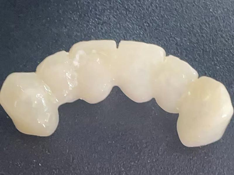 Čo je to „dočasná koruna“? Prečo ho potrebujete?