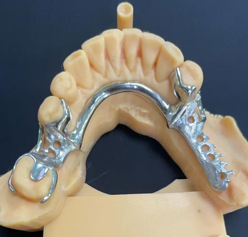 Výhody kobalt-chrómového rámca (Co Cr Framework)