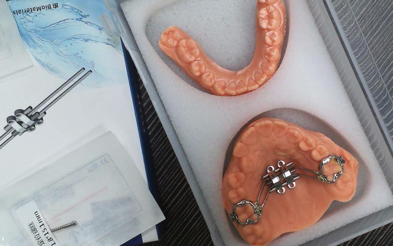 Pochopte rozšírenie kostry MSE s WM Dental Lab