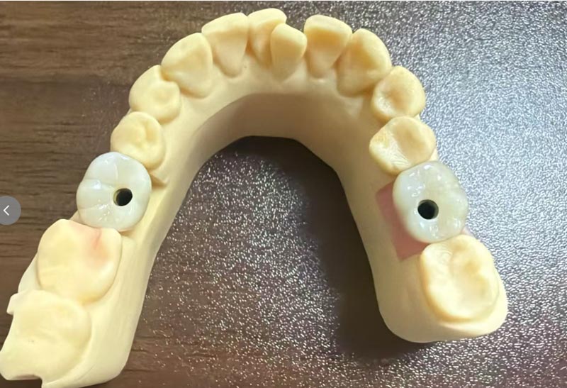 Prečo je implantácia predných zubov ťažšia ako implantácia zadných zubov?