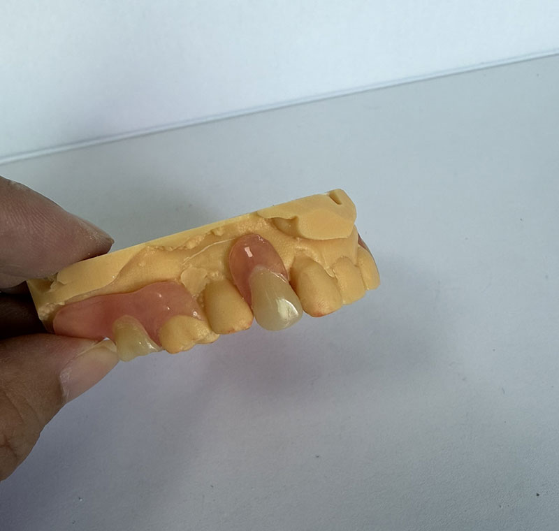 Valplast Partials vo WM Dental Lab