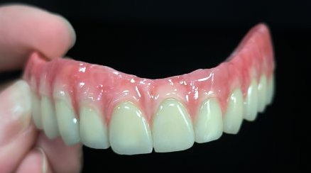 Všetky na 4 hybridných - Malo Bridge Full Zirconia Crowns Over Titanium Structures