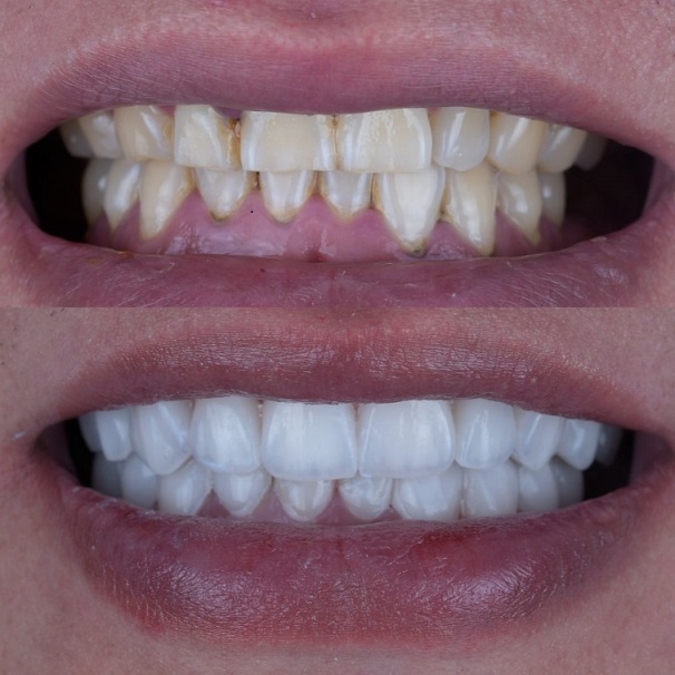 Emax Layered Veneers Esthetic China Dental Lab práca