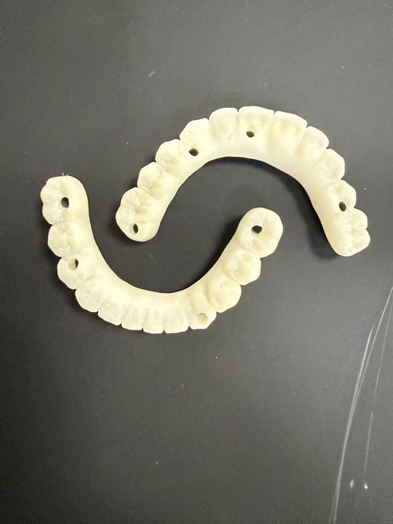 bar-clip implant-retained